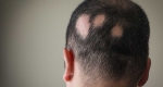 آلوپسی آره آتا (Alopecia Areata)