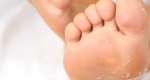 علت پوسته شدن کف پا چیست؟