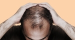 اثر ریزش موی مردان