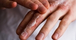 ایکتیوز چیست و چگونه می توان پوست خود را درمان کرد؟