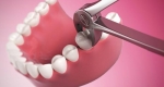 بایدها و نبایدهای بعد از کشیدن دندان