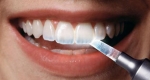 میناکاری دندان چیست؟