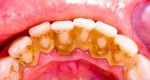  درمان تارتار دندان