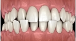 کراودینگ دندان چیست؟